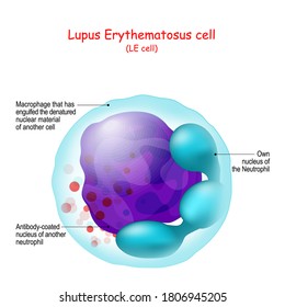 Lupus Erythematosus Cell. Structure Of LE Cell. Human Anatomy Close Up Of Neutrophil Or Macrophage That Has Engulfed The Denatured Nuclear Material Of Another Cell.