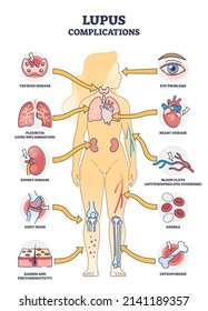 Lupus erythematosus medical autoimmune disease complications outline diagram. Labeled educational scheme with body immune system illness symptoms and anatomical consequences list vector illustration.