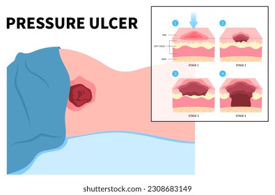 Lying down or sitting prolonged period time with paralysis patient cause Bedsores pressure ulcer injury skin underlying tissue from immobility adults