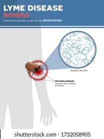 Lyme borreliosis infection caused by tick bite, colorful info poster