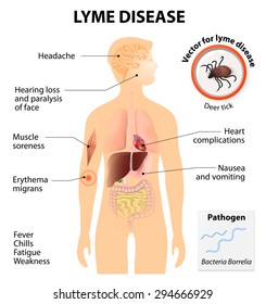 Lyme Disease Or Lyme Borreliosis Is An Infectious Illness Transmitted By Ticks That Can Affect Dogs And People. Signs And Symptoms. Human Silhouette With Highlighted Internal Organs.