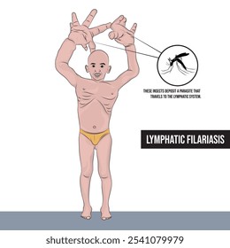 Lymphatic filariasis or elephantiasis is spread by infected mosquitoes, infecting the skin and lymphatic tissue.
