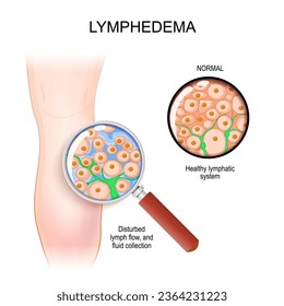 Linfhedema. Cierre de un sistema linfático saludable de una pierna humana. lupa y flujo linfático perturbado con captación de fluidos en el espacio intercelular. Comparación y Diferencia. Vector 