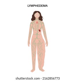 Lymphedema disease concept. Swelling of female legs or arms. Damaged lymph nodes in human obesity body. Overweight problem and elephantiasis. Disorder in the lymphatic system flat vector illustration.