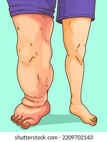 Lymphedema. Edema. Medical illustration. Vector illustration.
