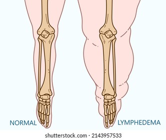 Lymphedema. Edema. Medical infographic: human legs and bones, human body health problems. Medical illustration. Vector illustration.