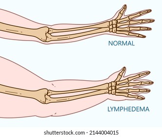 lymphoedème. Oedème. Infographie médicale: les mains : image ...