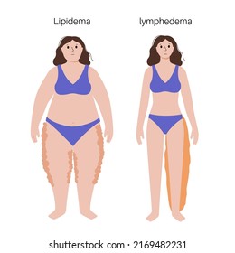 Lymphedema and lipedema disease concept. Swelling of female legs. Damaged lymph nodes in human obesity body. Overweight problem and elephantiasis. Disorder in lymphatic system flat vector illustration svg