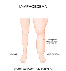 Lymphedema. Lower extremity lymphatic obstruction. Comparison and difference of Healthy leg, and leg with lymphatic insufficiency. Swelling of legs. Overweight problem. elephantiasis.