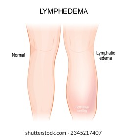 Linfhedema. linfedema. Pierna sana y edema linfático. hinchazón de la pierna y el pie causada por un sistema linfático comprometido. Parte del cuerpo humano. Ilustración del vector