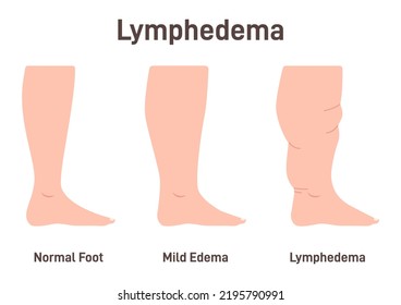 Lymphedema stages. Lymphatic system dysfunction disease. Swollen legs, lymph fluid transportation disorder. Flat vector illustration