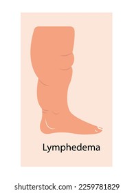 Estadios de linfedema. Trastornos del sistema linfático Piernas hinchadas, trastorno del transporte de líquidos linfáticos. Ilustración vectorial plana
