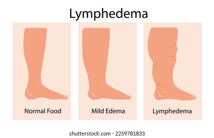 Lymphedema stages. Lymphatic system dysfunction disease. Swollen legs, lymph fluid transportation disorder. Flat vector illustration