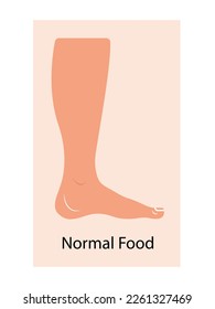 Lymphedema stages. Lymphatic system dysfunction disease. Swollen legs, lymph fluid transportation disorder. Flat vector illustration