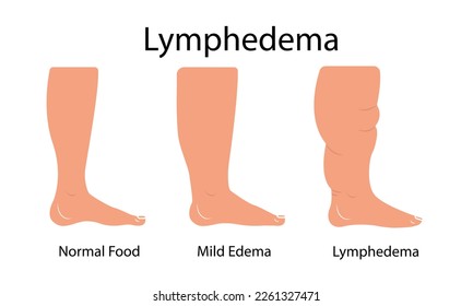 Lymphedema stages. Lymphatic system dysfunction disease. Swollen legs, lymph fluid transportation disorder. Flat vector illustration