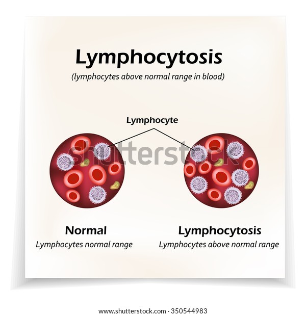 Lymphocytes Above Normal Range Blood Lymphocytosis Stock Vector ...