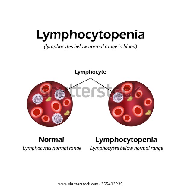 Lymphocytes Below Normal Range Blood Lymphocytopenia Stock Vector ...