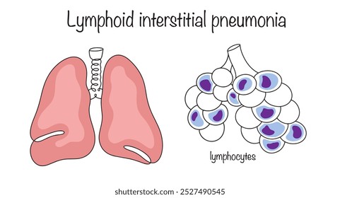 Neumonía intersticial linfoide. Enfermedad pulmonar en la cual los linfocitos maduros se acumulan en los alvéolos. Una ilustración simple para su uso en el campo médico. Ilustración vectorial.