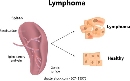 Lymphoma