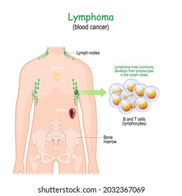 Lymphoma Or Blood Cancer. Human's Body With Lymphatic System. Close-up Of White Blood Cells. Vector Illustration.