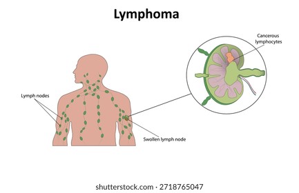  Lymphom (Krebs des Lymphsystems), Vektorgrafik