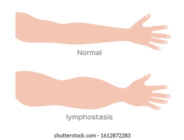 lymphostasis arm vector on white background