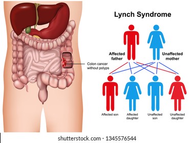 Lynch syndrome disease 3d medical vector illustration on white background