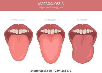 Macroglossia tongue disease. Oral medicine. Medical infographic design. Vector illustration