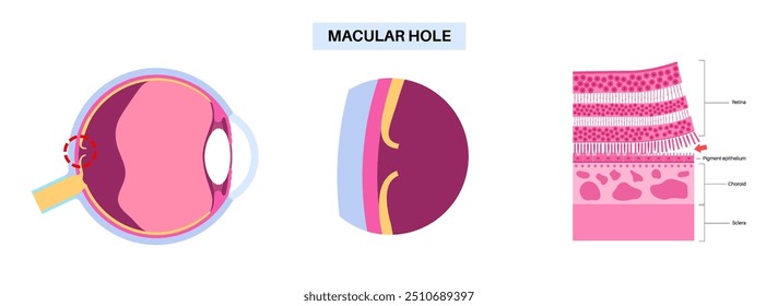 Macula hole eye disease anatomical poster. Age related full thickness disorder of vision. Retina and human eyeball anatomy. Blur the central vision. Retina deficiency medical flat vector illustration