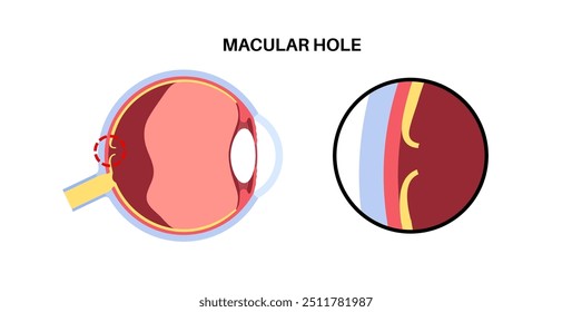 Macula hole eye disease anatomical poster. Age related full thickness disorder of vision. Retina and human eyeball anatomy. Blur the central vision. Retina deficiency medical flat vector illustration