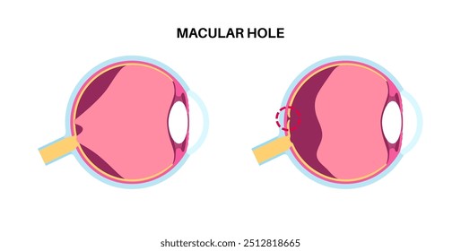 Cartaz anatômico da doença ocular do buraco de mácula. Distúrbio de visão de espessura total relacionado à idade. Retina e anatomia do olho humano. Desfocar a visão central. Ilustração do vetor plano médico da deficiência de retina