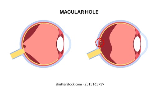 Afiche anatómico de la enfermedad ocular agujero mácula. Trastorno de la Edad relacionado con el grosor total de la visión. Retina y anatomía del globo ocular humano. Difuminar la visión central. Ilustración vectorial plana médica por deficiencia de retina