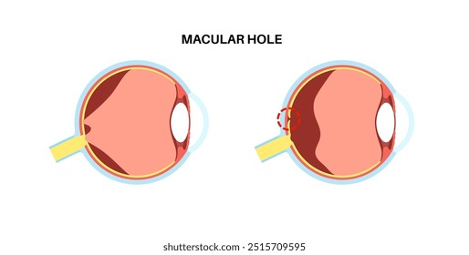 Cartaz anatômico da doença ocular do buraco de mácula. Distúrbio de visão de espessura total relacionado à idade. Retina e anatomia do olho humano. Desfocar a visão central. Ilustração do vetor plano médico da deficiência de retina