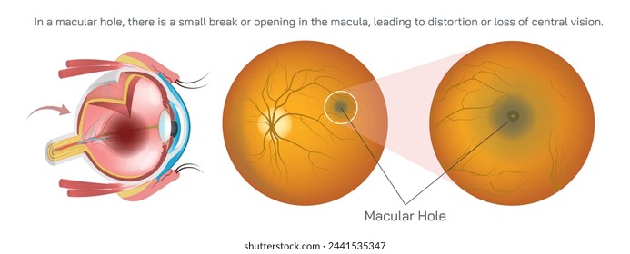 macula is responsible for sharp vision to do activities like reading and driving. In a macular hole, there is a small break or opening in the macula, leading to distortion or loss of vision vector. svg
