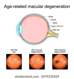 Macular degeneration. Age-related macular degeneration. Cross section of human eye. Close-up of a macula, optic disc, choroid, retina, sclera, fovea. Medical condition. Image of the back of the eye