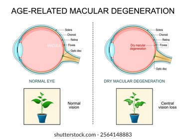 Macular degeneration. Age-related dry macular degeneration. AMD. Cross section of human eye. Central vision loss. Close-up of a macula, optic disc, choroid, retina, sclera, and fovea. Vector poster