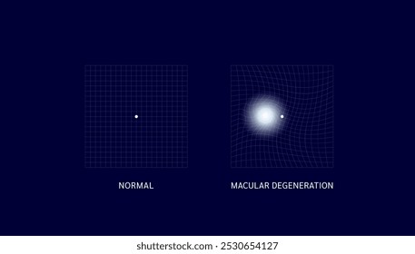 La degeneración macular es común. Visión normal y borrosa. Malla cuadrada con puntos blancos. Causa la pérdida de la visión solo en la parte central de la Imagen. Diagnóstico de ciencia médica. Vector EPS10.