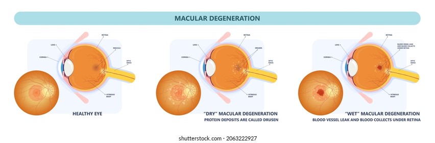 Macular Degeneration Dry Wet Age Hole Pucker Edema Eye Vision Loss AMD Retina Drusen Blind Spots Blood Vessels Leak Blurry Adult Lose Visual Field Exam Treat Contact Lens Myopia Older Tear	