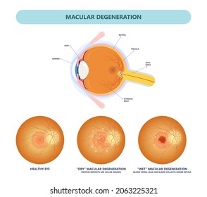 Macular Degeneration Dry Wet Age Hole Pucker Edema Eye Vision Loss AMD Retina Drusen Blind Spots Blood Vessels Leak Blurry Adult Lose Visual Field Exam Treat Contact Lens Myopia Older Tear