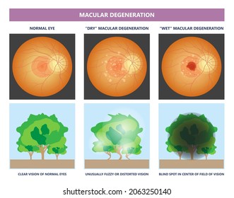 Macular Degeneration Dry Wet Age Hole Pucker Edema Eye Vision Loss AMD Retina Drusen Blind Spots Blood Vessels Leak Blurry Adult Lose Visual Field Exam Treat Contact Lens Myopia Older Tear Hemorrhage