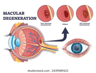 Macular degeneration as eye illness and eyesight problem outline diagram. Labeled educational scheme with central vision loss disease with wet or dry types vector illustration. Medical retina health.