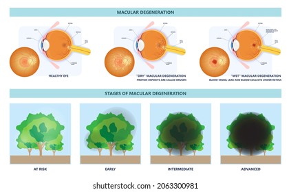 Macular Degeneration Hemorrhage Dry Wet Age Hole Pucker Edema Eye Vision Loss AMD Retina Drusen Blind Spots Blood Vessels Leak Blurry Adult Lose Visual Field Exam Treat Contact Lens Myopia Older Tear