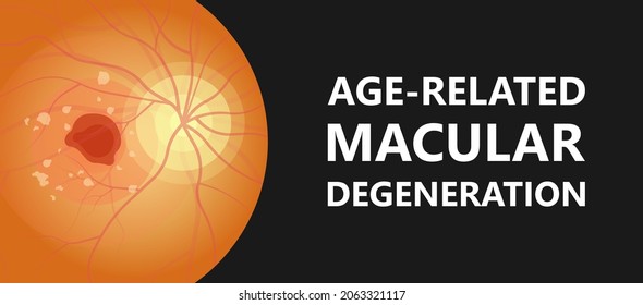 Macular Degeneration Hemorrhage Dry Wet Age Hole Pucker Edema Eye Vision Loss AMD Retina Drusen Blind Spots Blood Vessels Leak Blurry Adult Lose Visual Field Exam Treat Contact Lens Myopia Older Tear