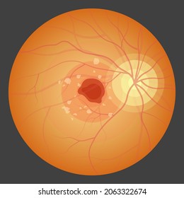 Macular Degeneration Hemorrhage Dry Wet Age Hole Pucker Edema Eye Vision Loss AMD Retina Drusen Blind Spots Blood Vessels Leak Blurry Adult Lose Visual Field Exam Treat Contact Lens Myopia Older Tear