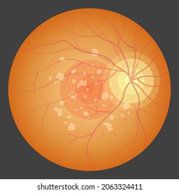 Macular Degeneration Hemorrhage Dry Wet Age Hole Pucker Edema Eye Vision Loss AMD Retina Drusen Blind Spots Blood Vessels Leak Blurry Adult Lose Visual Field Exam Treat Contact Lens Myopia Older Tear