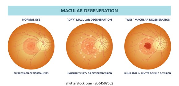 Optischer Disc-Fundus der Augentina-Anatomie