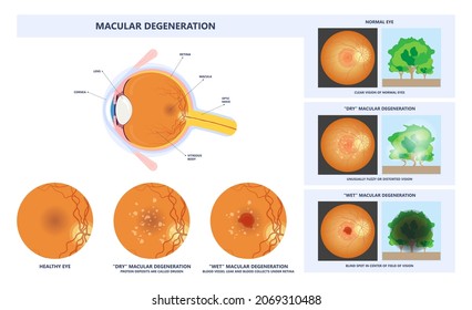 Macular Degeneration Hemorrhage Dry Wet Age Hole Pucker Edema Eye Vision Loss AMD Retina Drusen Blind Spots Blood Vessels Leak Blurry Adult Lose Visual Field Exam Treat Contact Lens Myopia Older Tear