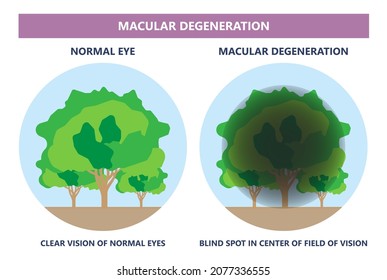 Macular Degeneration Hemorrhage Dry Wet Age Hole Pucker Edema Eye Vision Loss AMD Retina Drusen Blind Spots Blood Vessels Leak Blurry Adult Lose Visual Field Exam Treat Contact Lens Myopia Older Tear