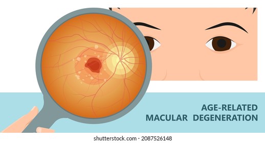 Macular Degeneration Hemorrhage Dry Wet Age Hole Pucker Edema Eye Vision Loss AMD Retina Drusen Blind Spots Blood Vessels Leak Blurry Adult Lose Visual Field Exam Treat Contact Lens Myopia Older Tear