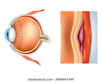 Macular degeneration, also known as age-related macular degeneration.AMD or ARMD. Damage to the macula